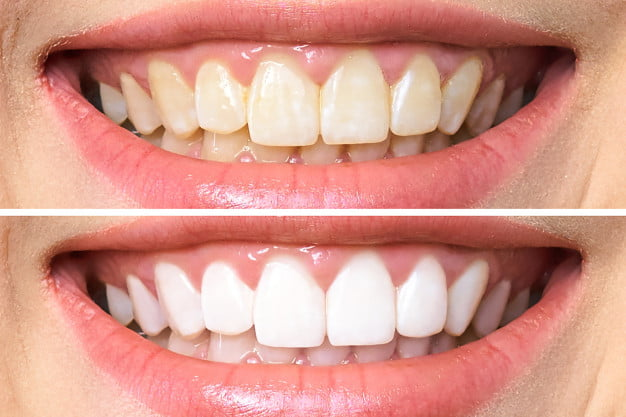 Blanqueamiento Dental - Antes y Después